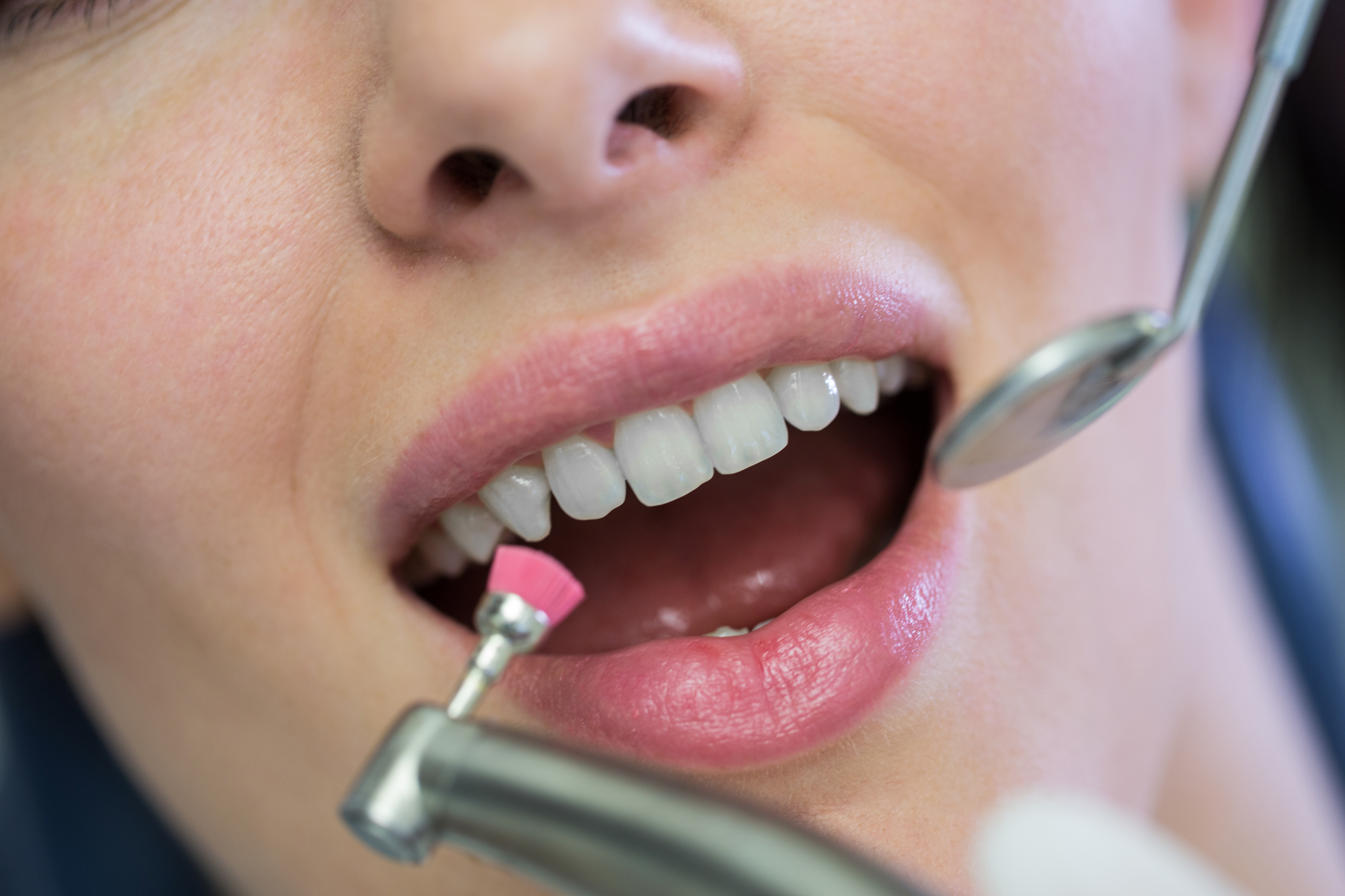 Tooth Fillings